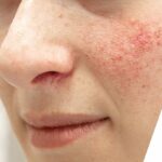 What is rosacea? A dermatologist’s guide to symptoms and treatments
