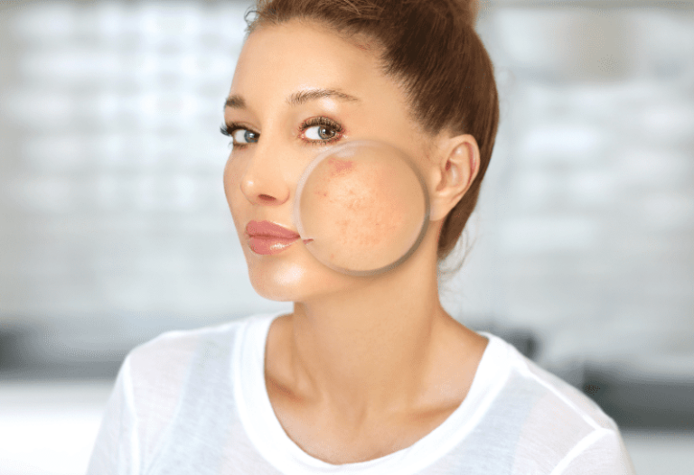 Acne and pregnancy