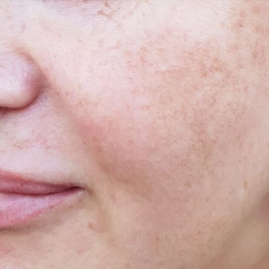 pigmentation treatment harley street