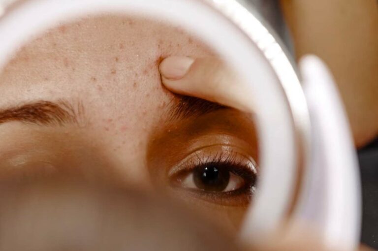 acne treatment london