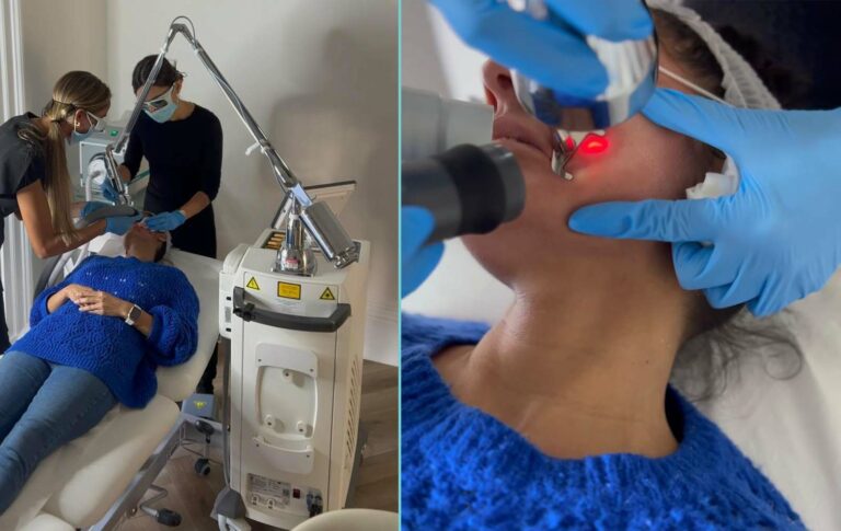acne scarring laser