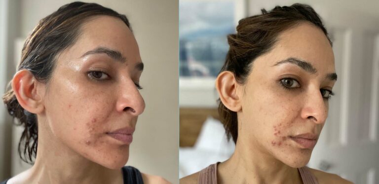Acne Treatment at Self London