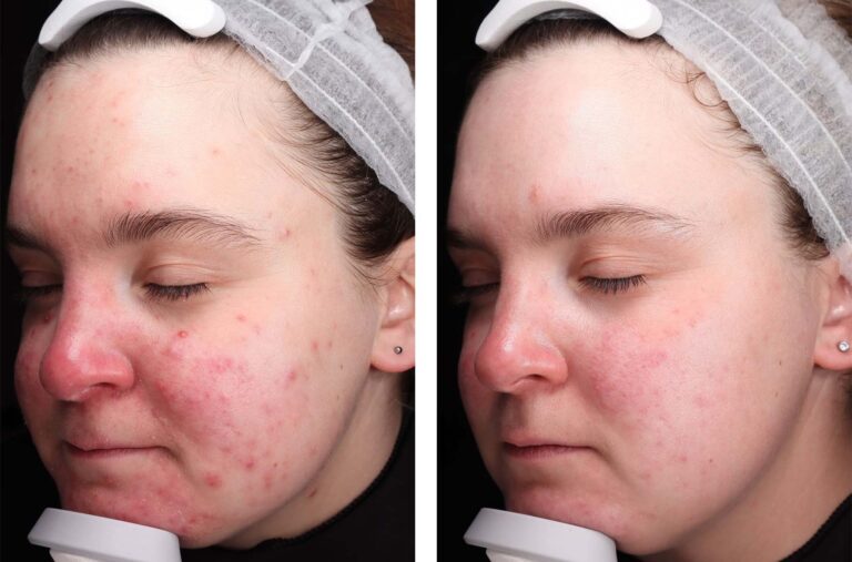5 Reasons Your Acne Treatments Aren't Working & How to Fix