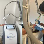 The best new laser and energy treatments to squeeze in before summer