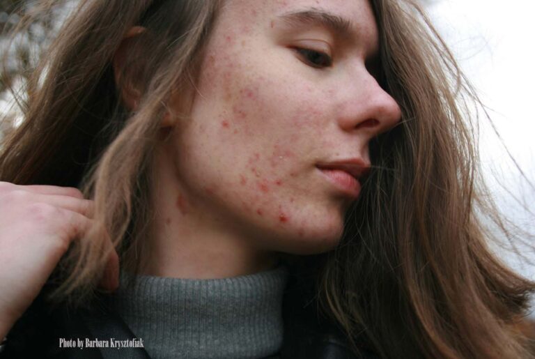 acne dermatologist