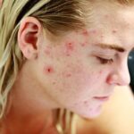 The Laser Gap: Why Acne Management in UK Dermatology Needs to Evolve