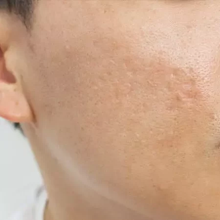 AM-med-derm-FEATURED-acne-scarring