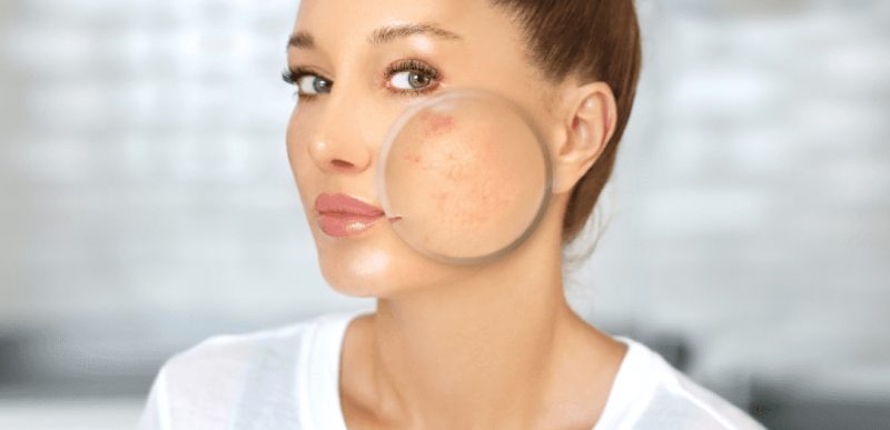 Acne-and-pregnancy 1