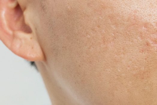 acne scar removal acne scar removal harley street
