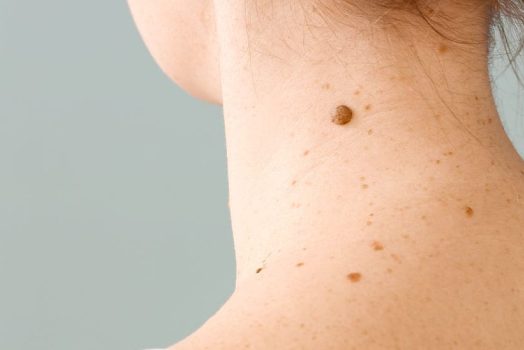 moles 1