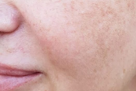 pigmentation treatment pigmentation treatment harley street